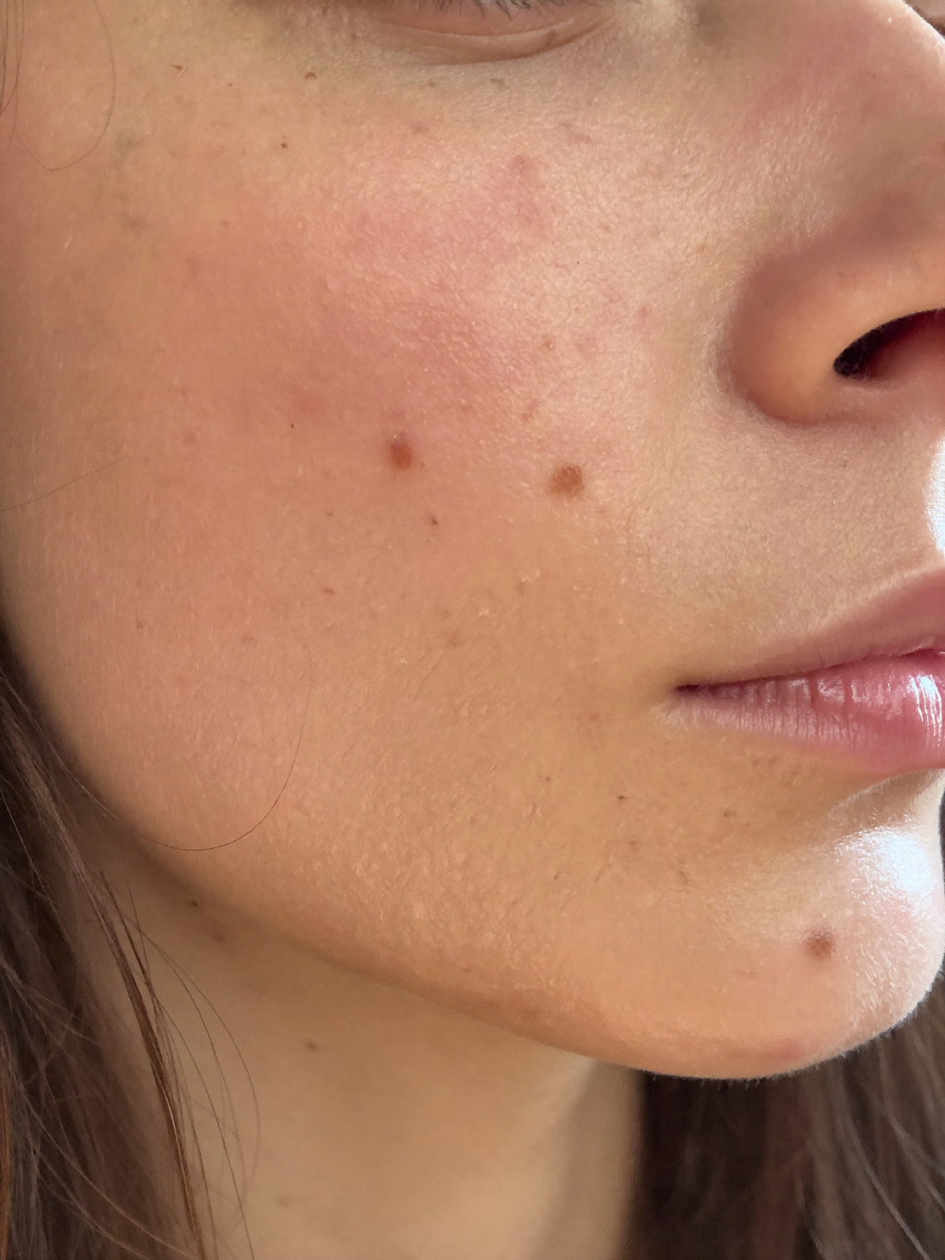 Close-up of facial skin with visible blemishes