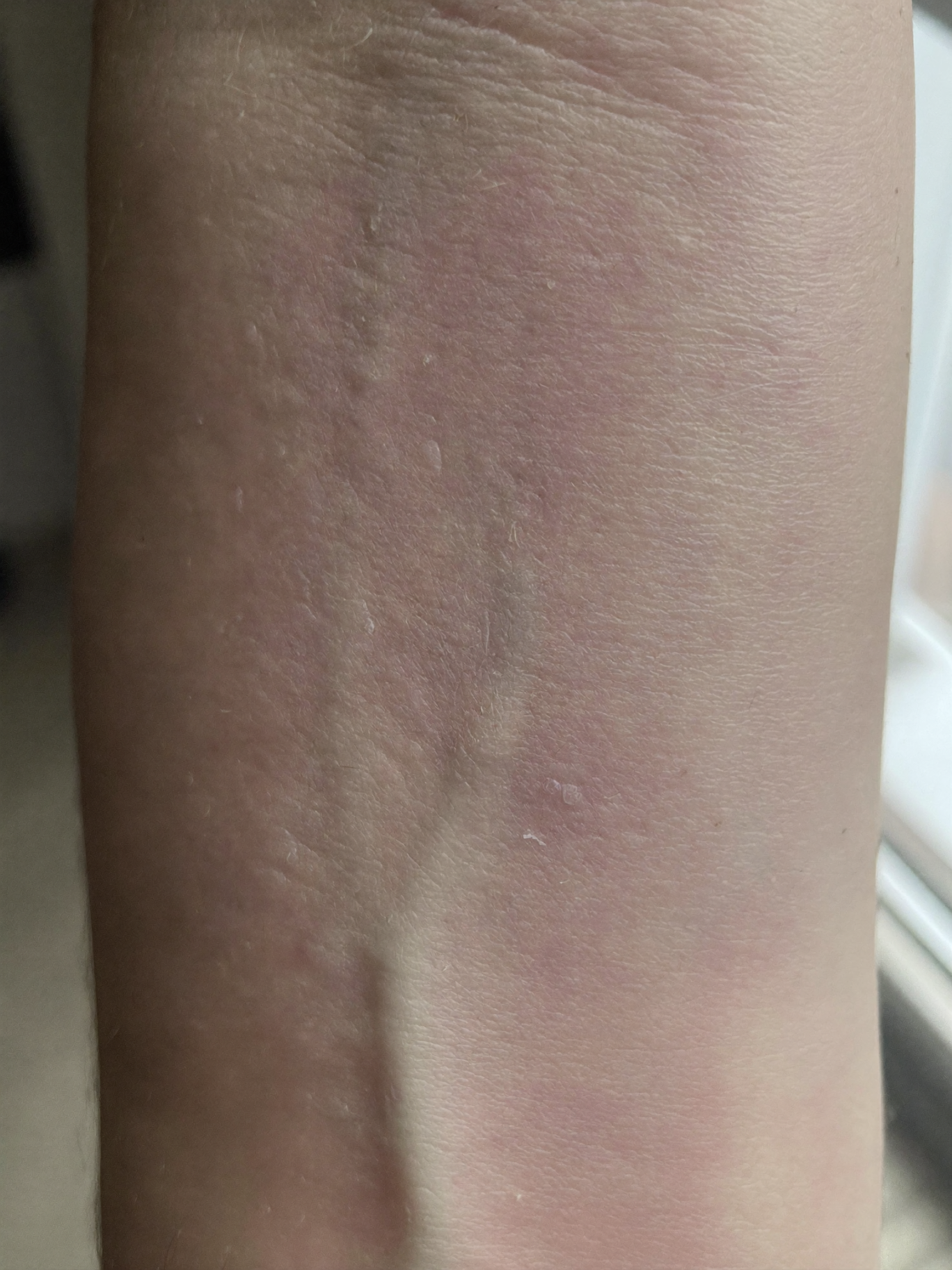 Close-up of dry skin on an arm